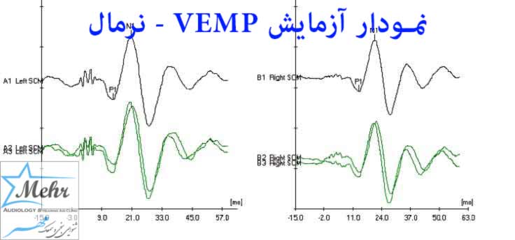 نمودار آزمایش VEMP نرمال