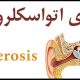 بیماری اتواسکلروزیس چیست؟